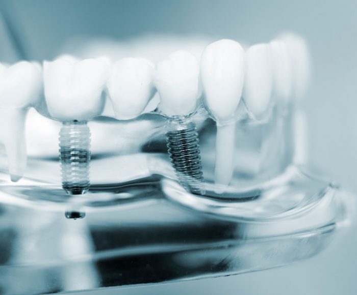 Dental-Implants-innerpage-img